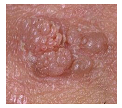 Hpv enfeksyonu nedir Human papilloma virus nedir, Human papilloma nedir